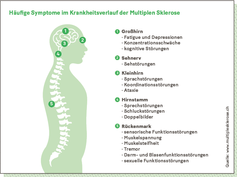 Infografik zu häufigen Symptomen im Krankheitsverlauf der Multiplen Sklerose.